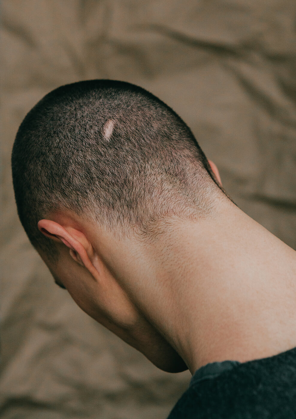 An editorial image of a back of mans head with a scar